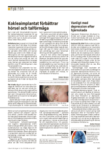 Kokleaimplantat förbättrar hörsel och talförmåga